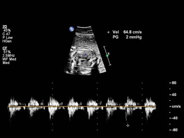 Fetal ekokardiyografi ile ultrasonografi ekranı.