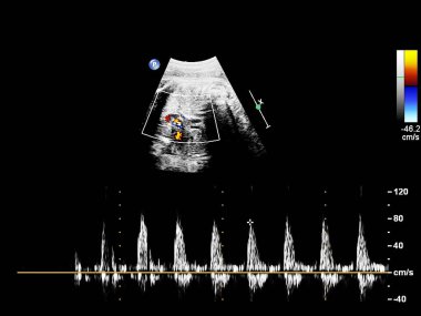 Fetal ekokardiyografi ile ultrasonografi ekranı.