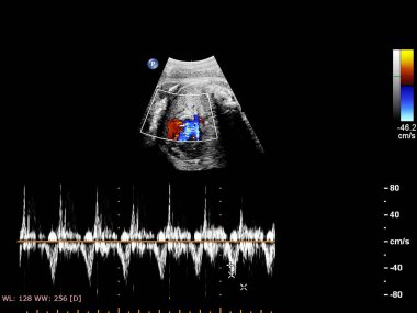 Fetal ekokardiyografi ile ultrasonografi ekranı.