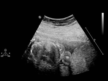 Fetal ekokardiyografi ile ultrasonografi ekranı.