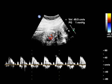 Fetal ekokardiyografi ile ultrasonografi ekranı.