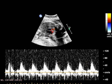 Fetal ekokardiyografi ile ultrasonografi ekranı.