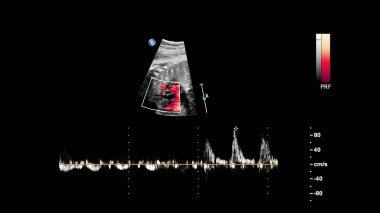 Fetal ekokardiyografi ile ultrasonografi ekranı.