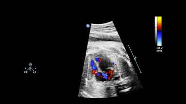 Fetal ekokardiyografi ile ultrasonografi ekranı.