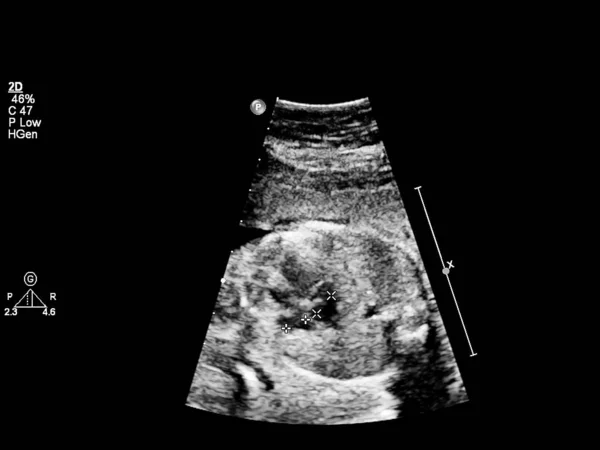 Ultrasound screen with fetal echocardiography. — Stock Photo, Image