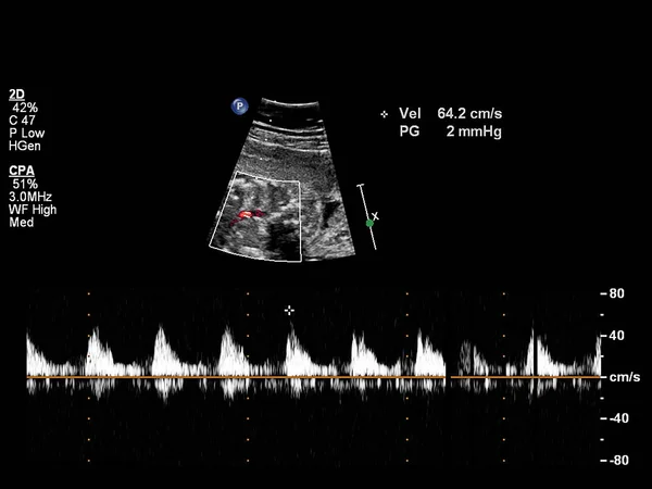 Fetal ekokardiyografi ile ultrasonografi ekranı. — Stok fotoğraf