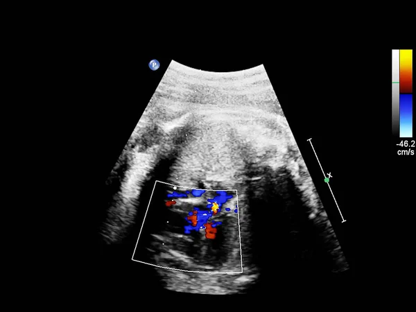 태아 심초음파를 가진 초음파 스크린. — 스톡 사진
