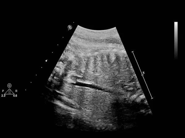 Ultraljud skärm med fetalt ekokardiografi. — Stockfoto