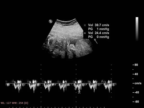 带胎儿超声心动图的超声屏幕. — 图库照片