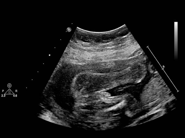 УЗИ с эхокардиографией плода
.