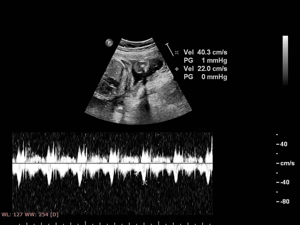 Ultrasound screen with fetal echocardiography. — Stock Photo, Image