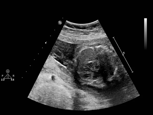 Ultrasound screen with fetal echocardiography. — Stock Photo, Image