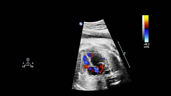 Schermo a ultrasuoni con ecocardiografia fetale . — Foto Stock