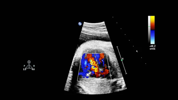 Ekran USG z echokardiografią płodu. — Zdjęcie stockowe