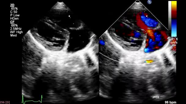 Schermo Una Macchina Ultrasuoni Con Immagine Del Cuore — Video Stock