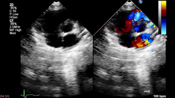 Екран Ультразвукової Машини Зображенням Серця — стокове відео