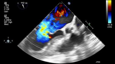 Kalbin ultrason transsofageal muayenesi.
