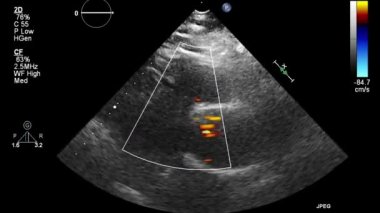 Kalbin ultrason transsofageal muayenesi.