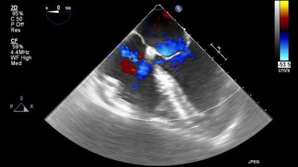 Kalbin Ultrason Transsofageal Muayenesi — Stok video