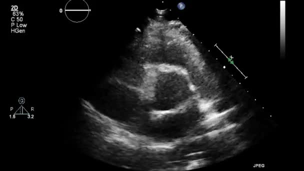 Kalbin Ultrason Transsofageal Muayenesi — Stok video