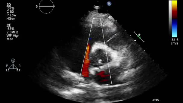 Ультразвуковое Трансофагеальное Исследование Сердца — стоковое видео