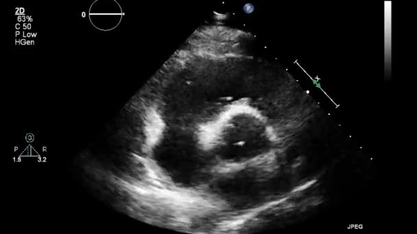 Ecografía Examen Transesofágico Del Corazón — Vídeos de Stock