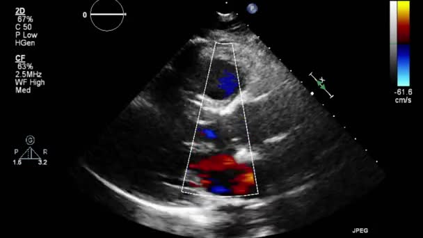 Ультразвуковое Трансофагеальное Исследование Сердца — стоковое видео