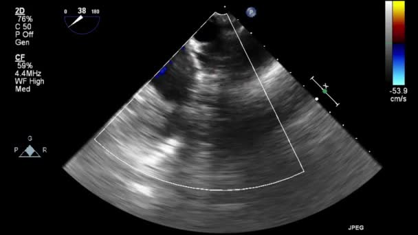 Ultrasound Transesophageal Examination Heart — Stock Video