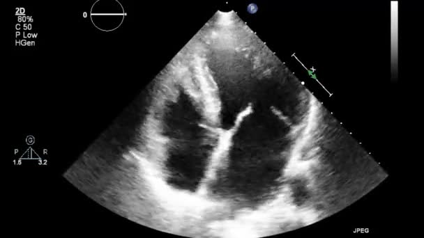 Ecografia Esame Transesofageo Del Cuore — Video Stock