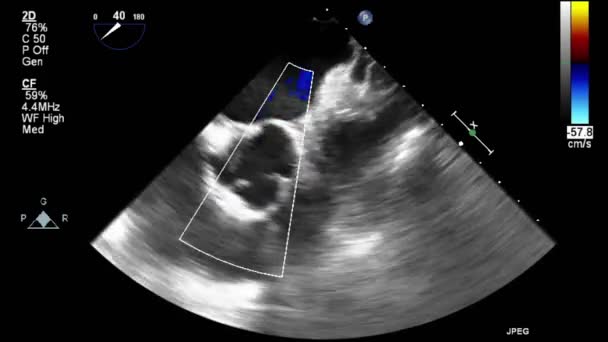 Ecografía Examen Transesofágico Del Corazón — Vídeo de stock