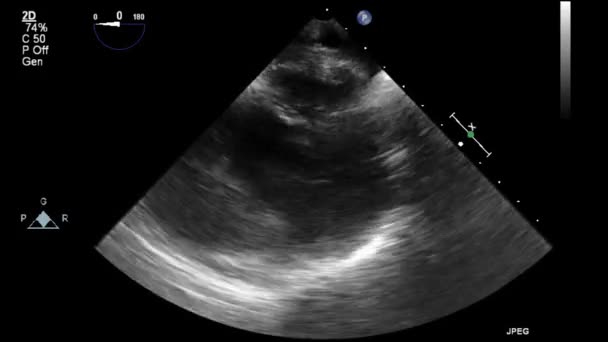 心臓の超音波経食道検査 — ストック動画