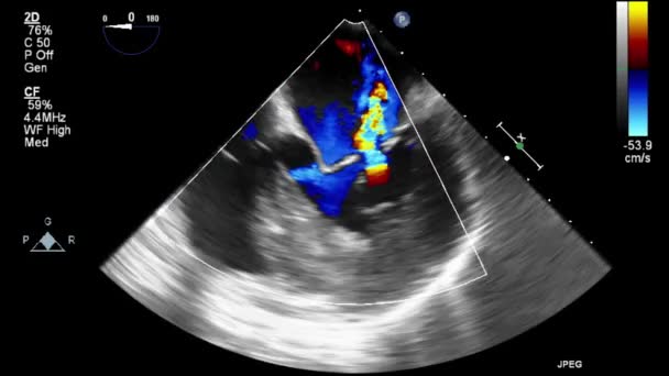 Ultraschall Transesophageale Untersuchung Des Herzens — Stockvideo