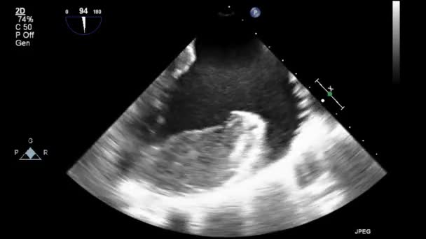 Echografie Transslokdarmonderzoek Van Het Hart — Stockvideo