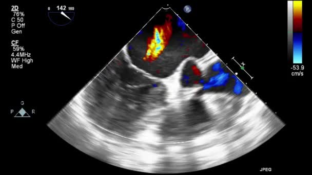 Ультразвуковое Трансофагеальное Исследование Сердца — стоковое видео
