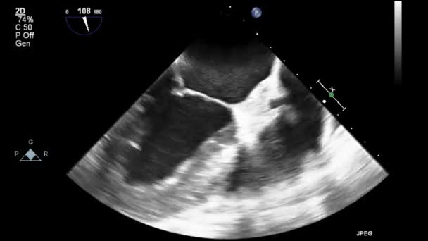 Ультразвуковое Трансофагеальное Исследование Сердца — стоковое видео