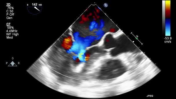 Ultrasound Transesophageal Examination Heart — Stock Video