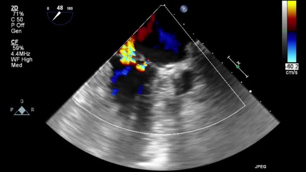 Ultrasound Transesophageal Examination Heart — Stock Video