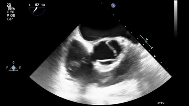 Echografie Transslokdarmonderzoek Van Het Hart — Stockvideo