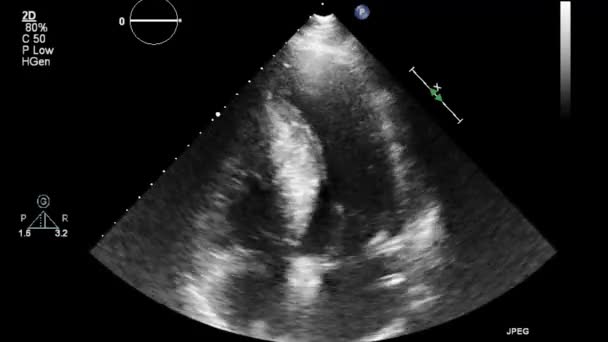 Usg Przełyku Przełyku Serca — Wideo stockowe