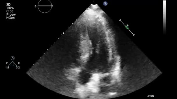 초음파 식도를 — 비디오