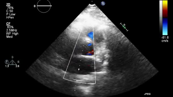 Ultraschall Transesophageale Untersuchung Des Herzens — Stockvideo