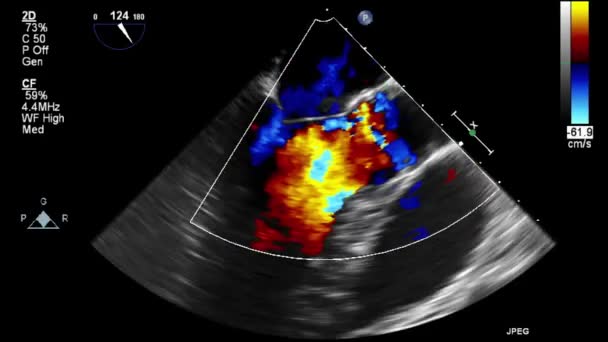 Ecografia Esame Transesofageo Del Cuore — Video Stock