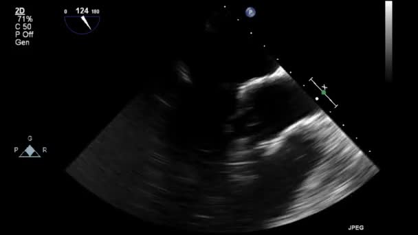 Ultraljudstransesofageal Undersökning Hjärtat — Stockvideo