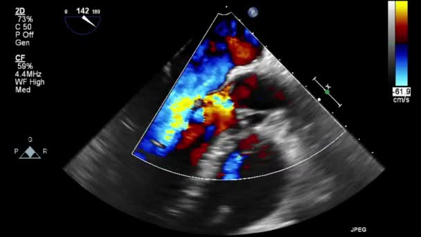 Ультразвуковое Трансофагеальное Исследование Сердца — стоковое видео