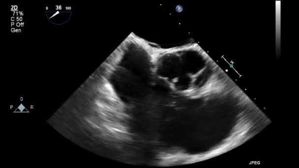 Exame Transesofágico Ultrassonográfico Coração — Vídeo de Stock