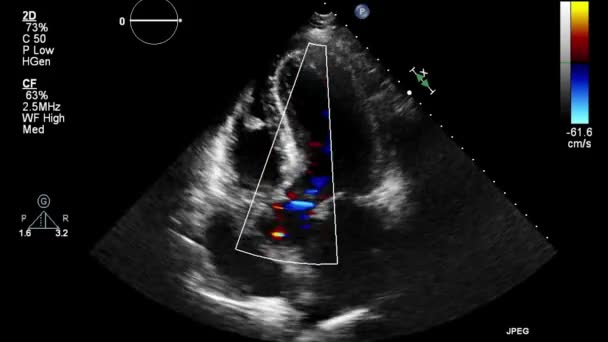 Ultraschall Transesophageale Untersuchung Des Herzens — Stockvideo