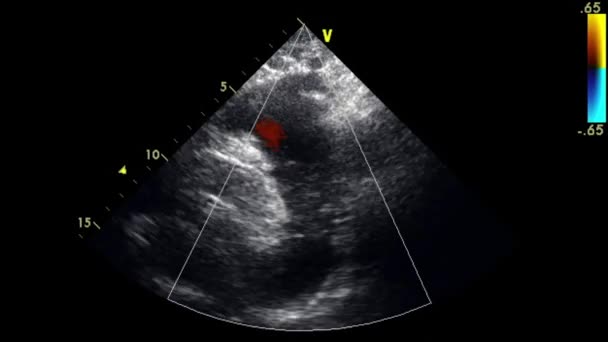 Ultraljudstransesofageal Undersökning Hjärtat — Stockvideo
