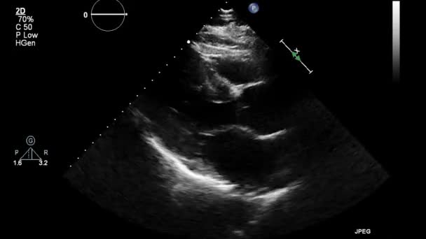 Kalbin Ultrason Transsofageal Muayenesi — Stok video