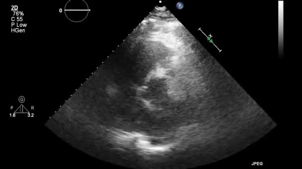 Kalbin Ultrason Transsofageal Muayenesi — Stok video