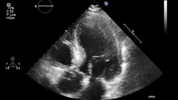 Ecografía Examen Transesofágico Del Corazón — Vídeo de stock